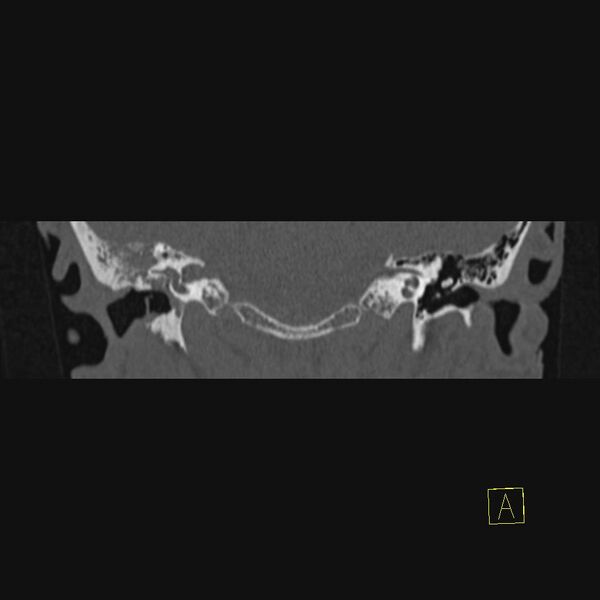 File:Chronic otitis media (Radiopaedia 14994-14912 Coronal bone window 9).JPEG