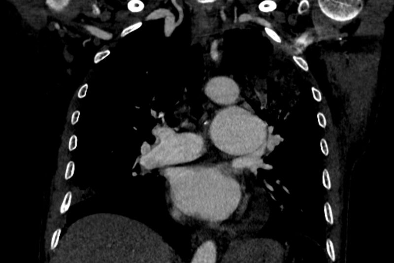 File:Chronic pulmonary embolism with bubbly consolidation (Radiopaedia 91248-108850 B 76).jpg