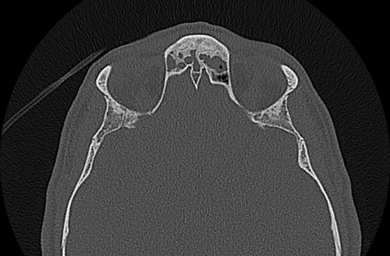 File:Chronic rhinosinusitis (Radiopaedia 65079-74075 Axial bone window 67).jpg