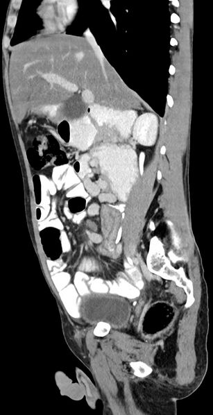 File:Chronic small bowel volvulus (Radiopaedia 75224-86322 C 91).jpg