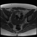 Class II Mullerian duct anomaly- unicornuate uterus with rudimentary horn and non-communicating cavity (Radiopaedia 39441-41755 Axial T1 15).jpg