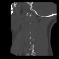 Clay-shoveler fracture (Radiopaedia 22568-22590 Sagittal bone window 41).jpg