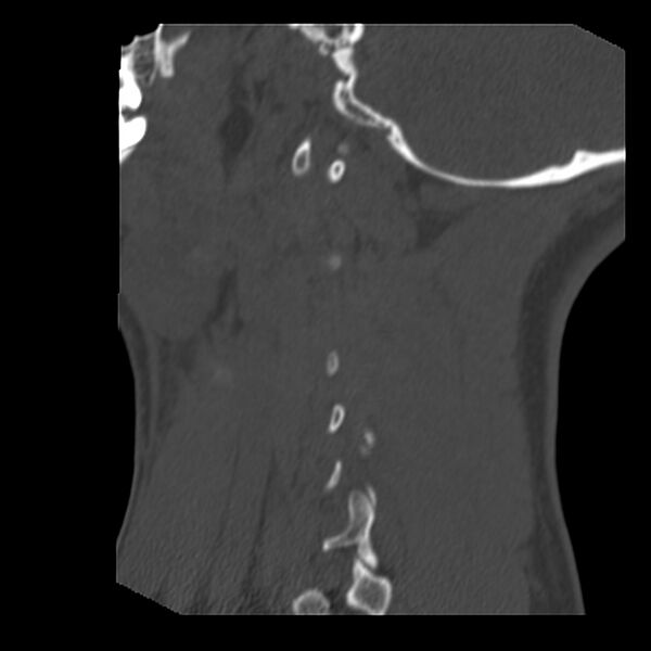 File:Clay-shoveler fracture (Radiopaedia 22568-22590 Sagittal bone window 41).jpg