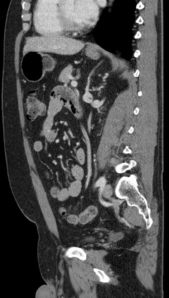 File:Clear cell renal cell carcinoma (Radiopaedia 61449-69393 G 44).jpg