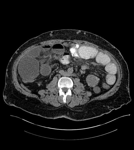 File:Closed-loop small bowel obstruction-internal hernia (Radiopaedia 78439-91096 Axial non-contrast 81).jpg