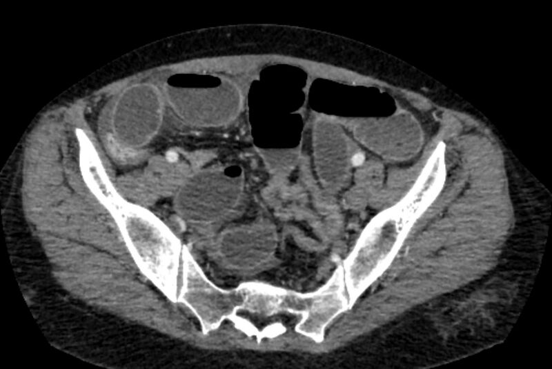 File:Closed loop small bowel obstruction (Radiopaedia 71211-81508 A 126).jpg