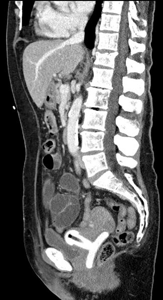 File:Closed loop small bowel obstruction - adhesive band with a C-shaped loop (Radiopaedia 83832-99018 C 65).jpg