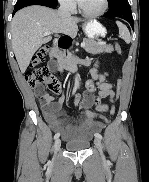File:Closed loop small bowel obstruction - internal hernia (Radiopaedia 57806-64778 A 48).jpg