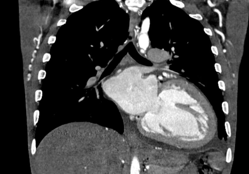 File:Coarctation of aorta with aortic valve stenosis (Radiopaedia 70463-80574 C 136).jpg