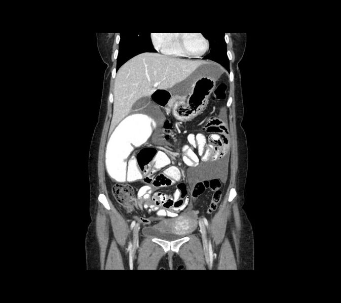 File:Cocoon abdomen with possible tubo-ovarian abscess (Radiopaedia 46235-50636 B 19).jpg
