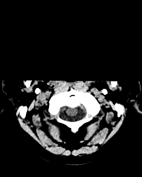 File:Colloid cyst of the third ventricle (Radiopaedia 86571-102661 Axial non-contrast 4).png
