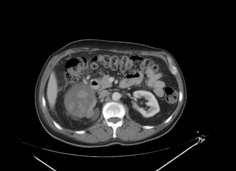 File:Colon cancer mimicking renal cell carcinoma (Radiopaedia 28986-29335 C 29).jpg