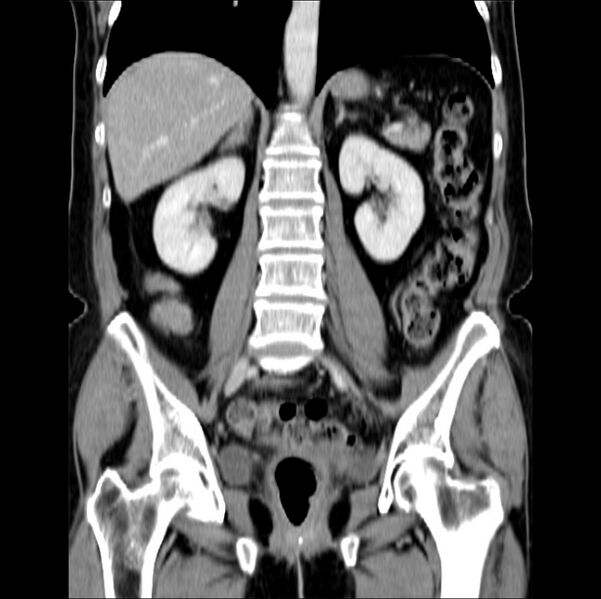 File:Colon carcinoma with hepatic metastases (Radiopaedia 29477-29961 B 27).jpg