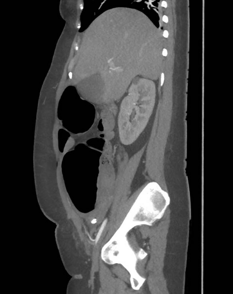 File:Colonic pseudo-obstruction (Radiopaedia 79752-92980 C 27).png