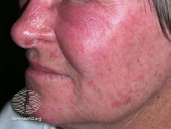 Contact allergic dermatitis