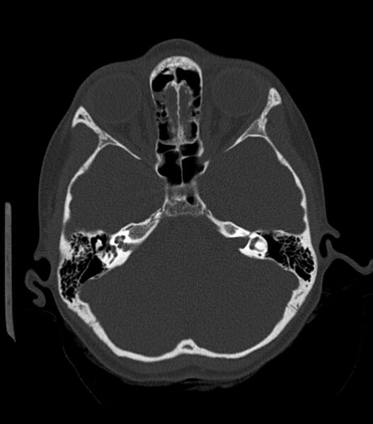 File:Nasoorbitoethmoid fracture (Radiopaedia 90044-107205 Axial bone window 83).jpg