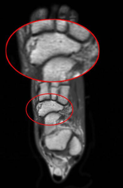 File:Navicular fracture (Radiopaedia 11662-12025 Axial 2).jpg
