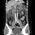 Necrotizing pancreatitis (Radiopaedia 23001-23031 B 33).jpg