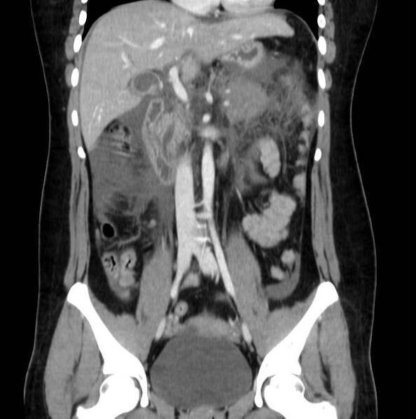 File:Necrotizing pancreatitis (Radiopaedia 23001-23031 B 33).jpg