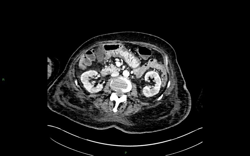 Neo-terminal ileal stricture (Crohn disease) (Radiopaedia 33790-34948 A 184).jpg
