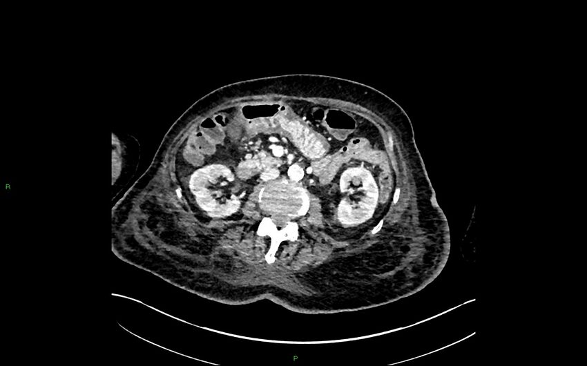 Neo-terminal ileal stricture (Crohn disease) (Radiopaedia 33790-34948 A 186).jpg