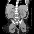 Neonatal neuroblastoma (Radiopaedia 56651-63438 Coronal non-contrast 36).jpg