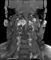Neurofibromatosis type 1 (Radiopaedia 80355-93740 I 6).jpg