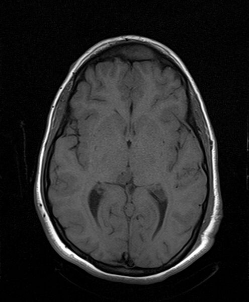 File:Neurofibromatosis type 2 (Radiopaedia 66211-75401 Axial T1 16).jpg