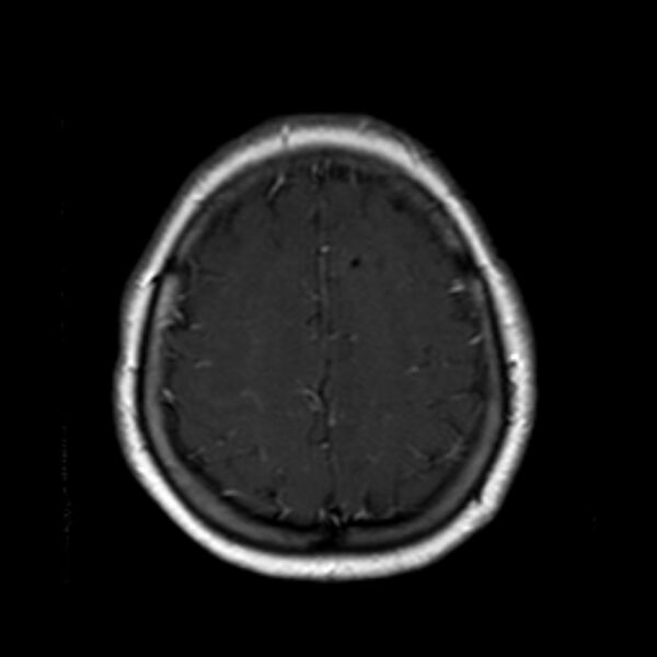 File:Neurofibromatosis type 2 (Radiopaedia 67470-76871 Axial T1 C+ 19).jpg