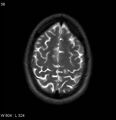 Neurosarcoidosis (Radiopaedia 10930-17204 Axial T2 17).jpg