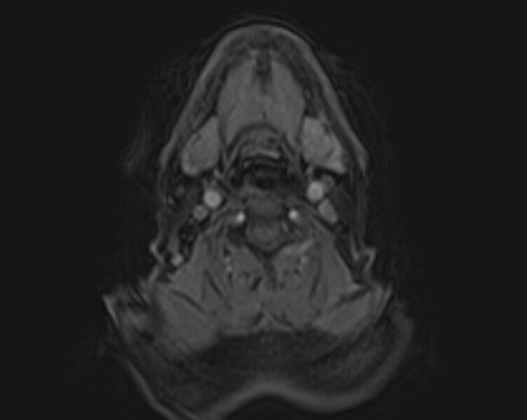File:Non-Hodgkin lymphoma - parotid gland (Radiopaedia 71531-81890 E 27).jpg