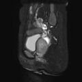 Non-puerperal uterine inversion (Radiopaedia 78343-90983 Sagittal T2 fat sat 19).jpg