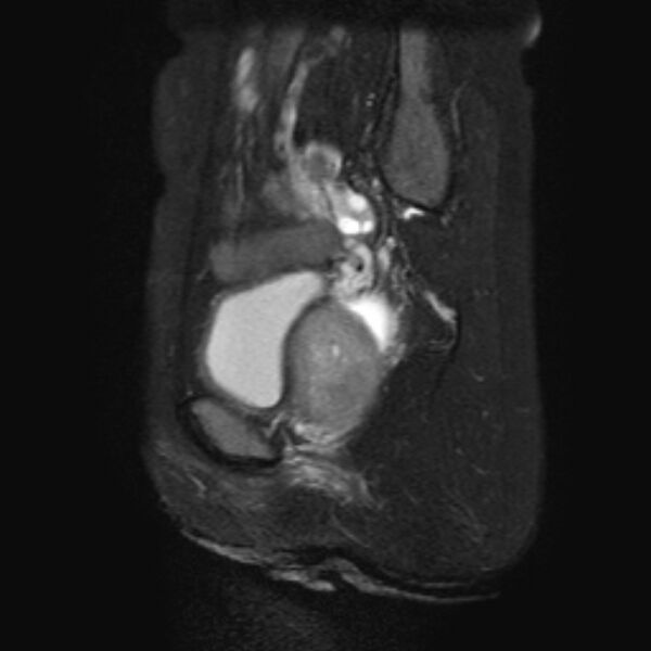 File:Non-puerperal uterine inversion (Radiopaedia 78343-90983 Sagittal T2 fat sat 19).jpg
