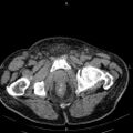 Non Hodgkin lymphoma in a patient with ankylosing spondylitis (Radiopaedia 84323-99621 Axial non-contrast 62).jpg