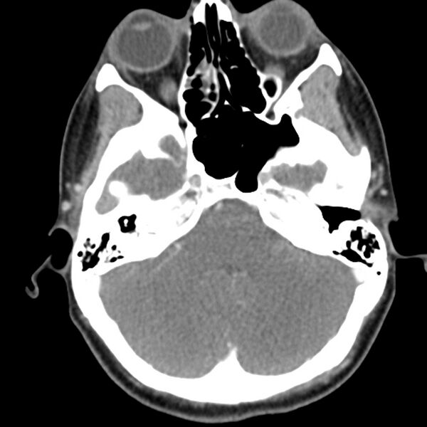 File:Normal CT of the neck (Radiopaedia 14575-14500 Axial C+ 10).jpg