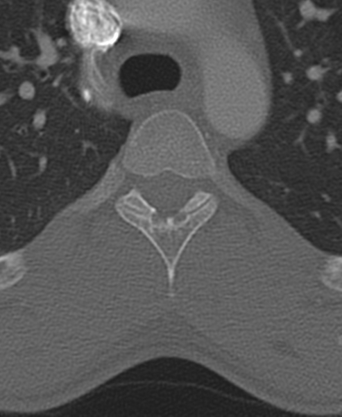 File:Normal CT thoracic spine (Radiopaedia 40181-42688 Axial bone window 34).png