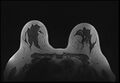 Normal breast MRI - dense breasts (Radiopaedia 80454-93850 Axial T1 141).jpg