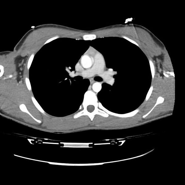 File:Normal dual-phase trauma CT chest,abdomen and pelvis (Radiopaedia 48092-52899 A 23).jpg