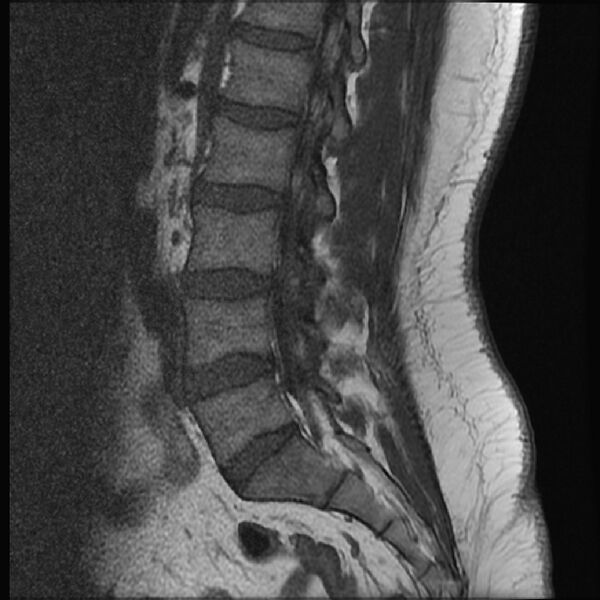 File:Normal lumbar spine MRI (Radiopaedia 43051-46311 Sagittal T1 12).jpg