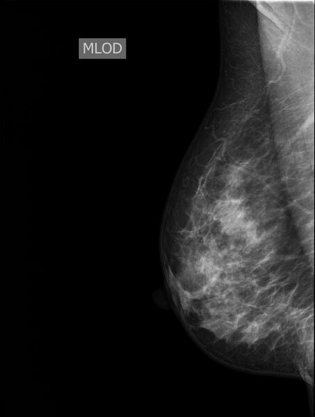 File:Normal mammogram radiographs (Radiopaedia 77107-89068 C 1).jpg