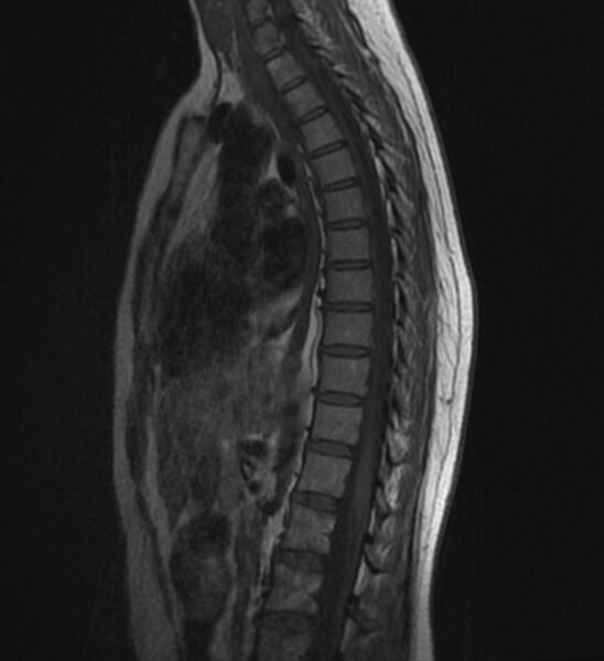 File:Normal thoracic spine MRI (Radiopaedia 41033-43781 Sagittal T1 8).jpg