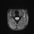 Normal trauma cervical spine (Radiopaedia 41017-43762 Axial T2 7).png