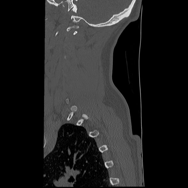 File:Normal trauma spine imaging (Radiopaedia 31753-32686 Sagittal bone window 4).jpg