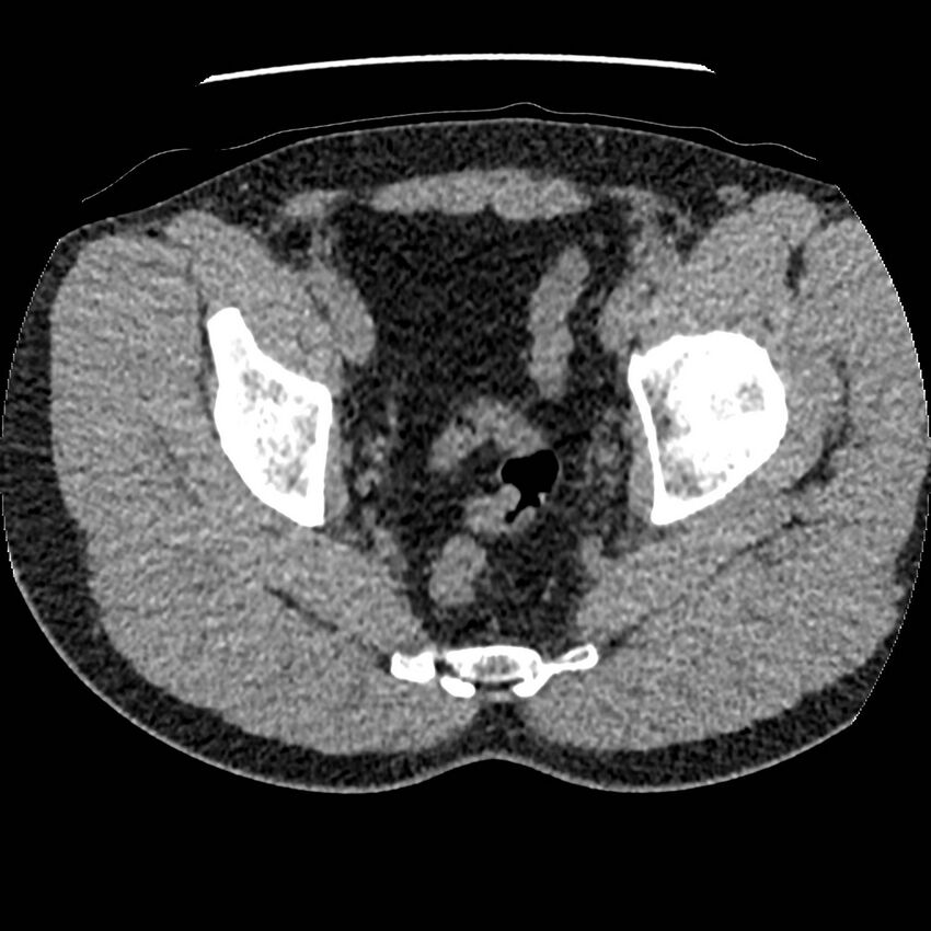 Obstructing ureteric calculus and ureteric anatomy (Radiopaedia 62730-71042 Axial non-contrast 149).jpg