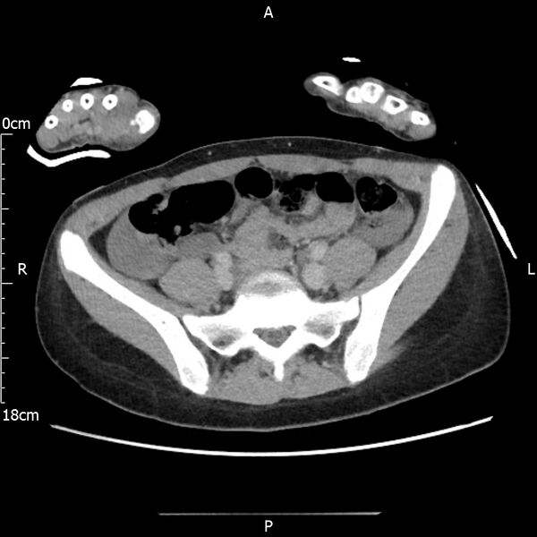 File:AAST grade IV kidney injury with CEUS follow-up (Radiopaedia 72353-82877 Axial C+ portal venous phase 53).jpg