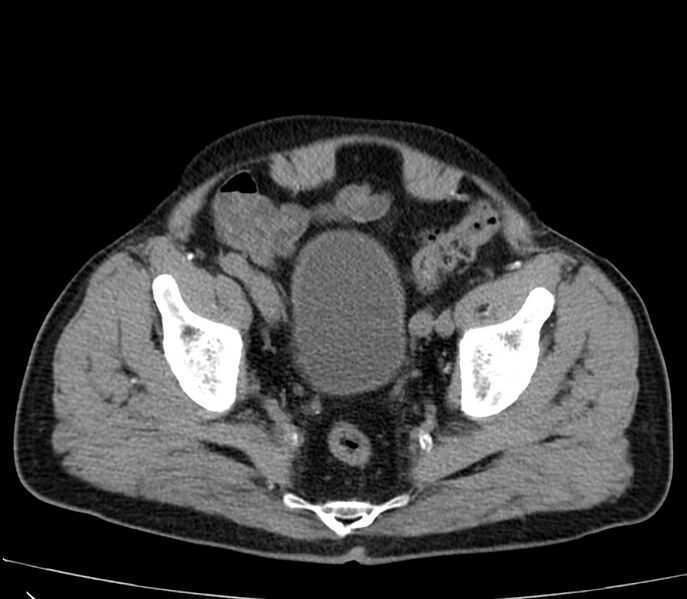 File:Abdominal aortic aneurysm (Radiopaedia 22421-22458 non-contrast 49).jpg