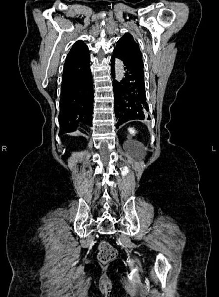 File:Abdominal aortic aneurysm (Radiopaedia 85063-100606 Coronal C+ arterial phase 49).jpg