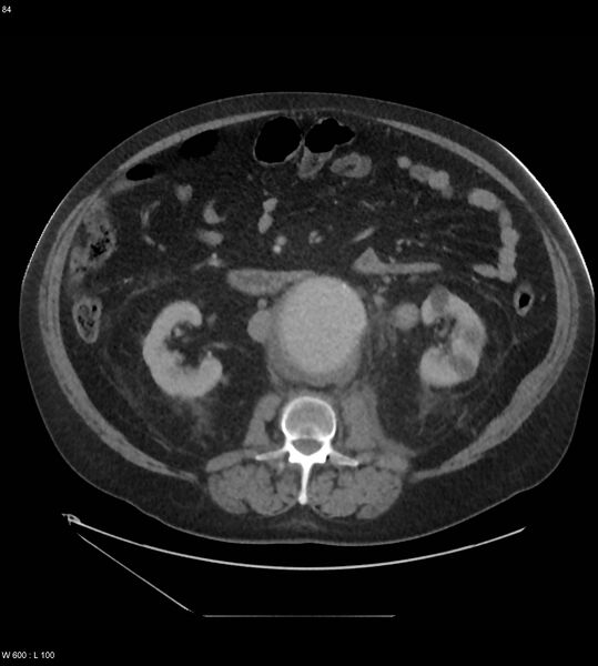 File:Abdominal aortic aneurysm with intramural hematoma then rupture (Radiopaedia 50278-55631 Axial C+ arterial phase 75).jpg