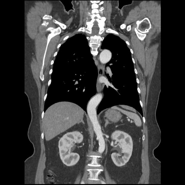 File:Aberrant right subclavian and left vertebral arteries (Radiopaedia 43467-46847 Coronal C+ portal venous phase 55).jpg