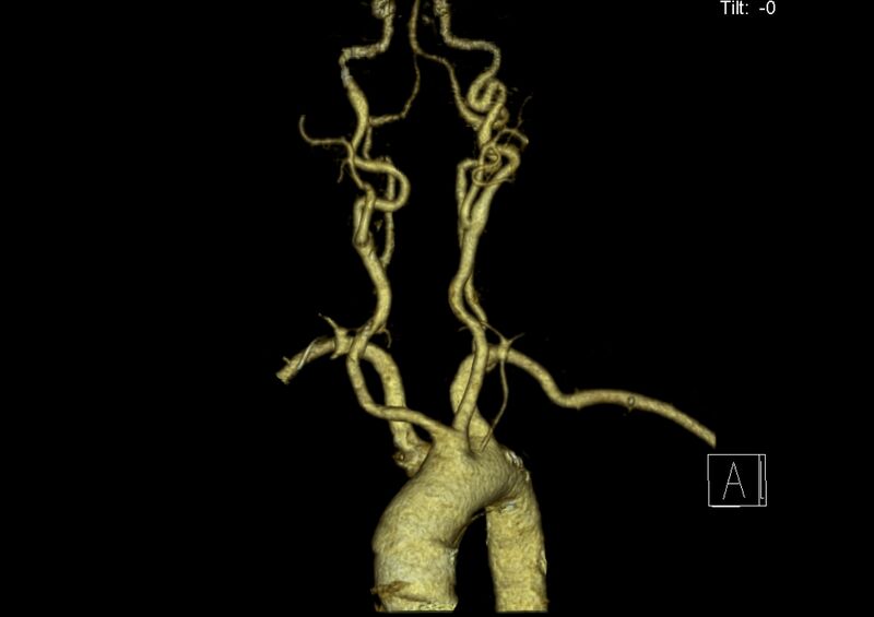 File:Aberrant right subclavian artery (Radiopaedia 19283-19294 3D reconstruction C+ arterial phase 7).jpg